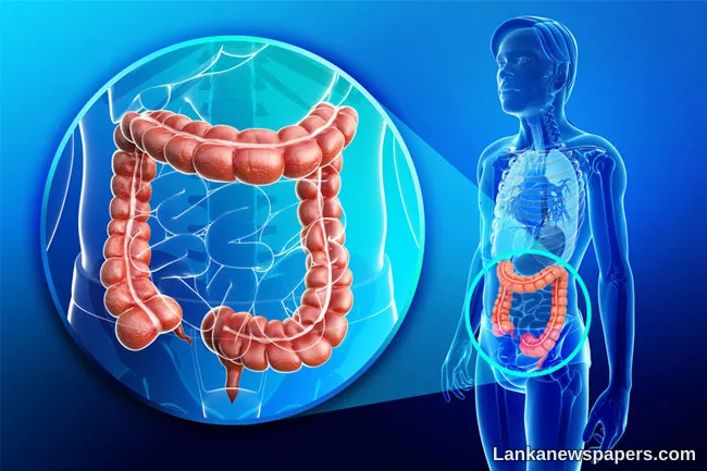 Alarming surge in colon and rectal cancers among 30–50 age group in Sri Lanka- Health authorities