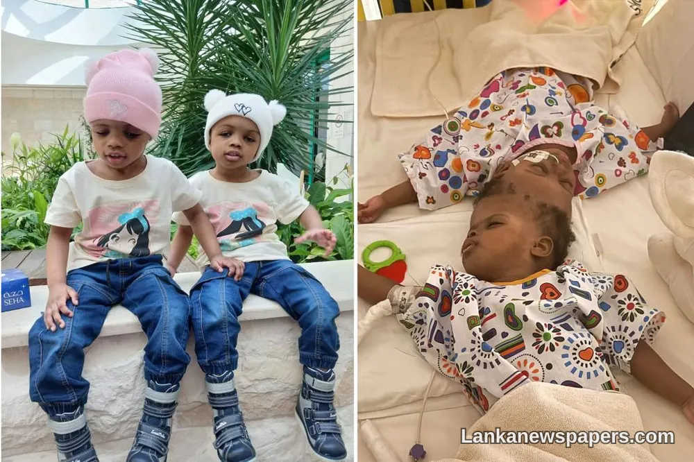 Pioneering AI-Assisted Surgery Successfully Separates Conjoined Twin Sisters Joined at the Head