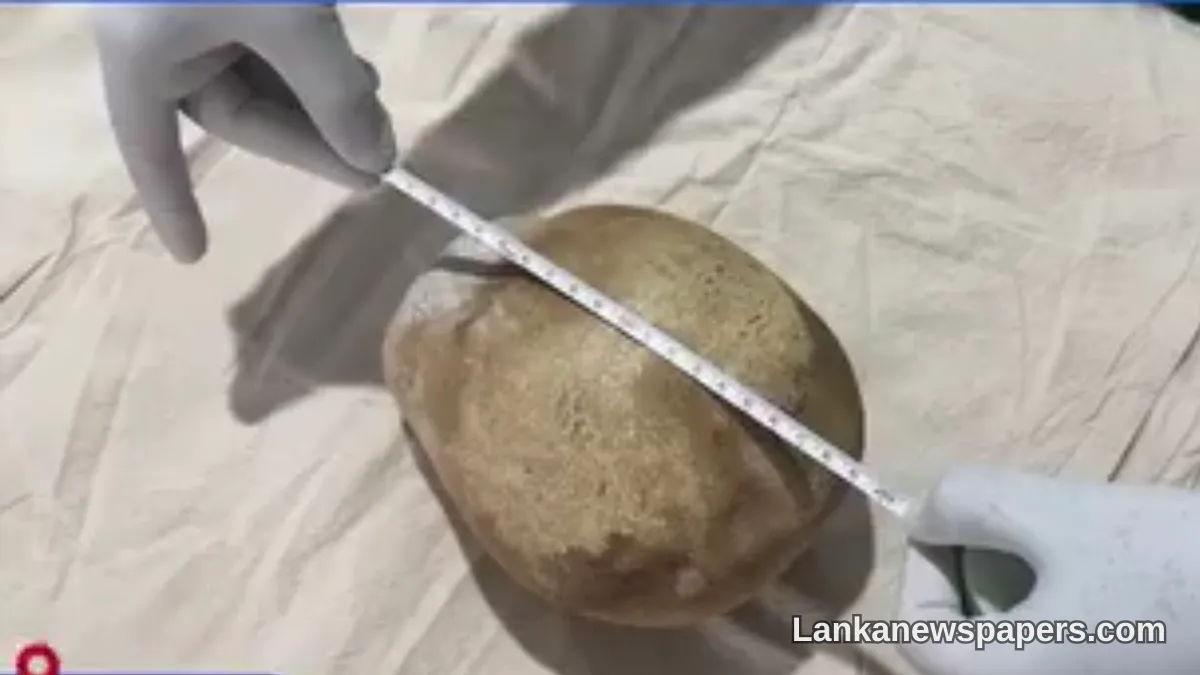 Trincomalee Surgeons Remove Massive 3.1kg Bladder Stone in Potential World Record Operation