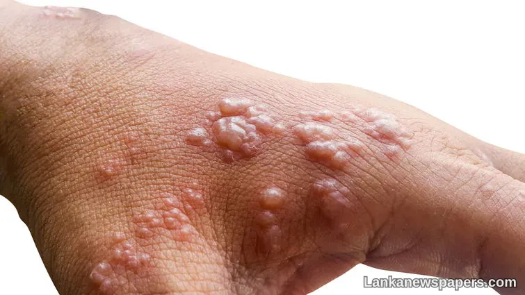 LNP - Sri Lanka braces for possible monkeypox threat