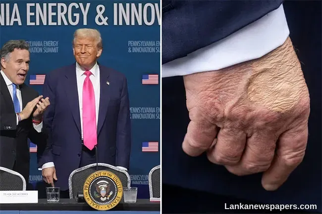 LNP - White House says Trump diagnosed with vein condition after questions about bruises