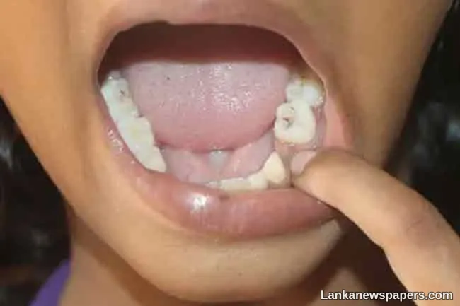 60% of Grade One entrants in Nuwara Eliya schools suffer from decayed teeth