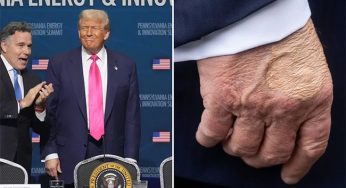 LNP – White House says Trump diagnosed with vein condition after questions about bruises